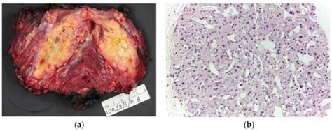 Clinics And Practice Free Full Text Imaging Features Of Alveolar