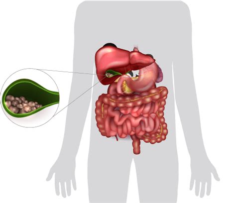 Cholecystectomy Gallbladder Removal Surgery Ugirs Melbourne