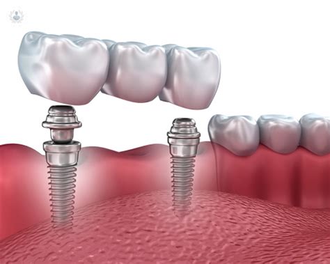 Cómo se debe preparar para un Implante Dental Top Doctors