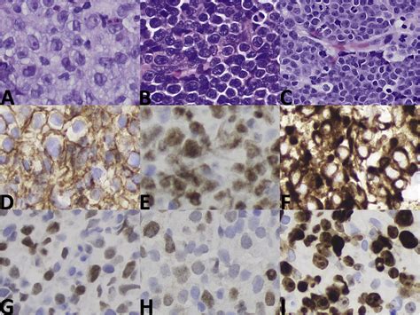 High Grade B Cell Lymphoma A Term Re Purposed In The Revised Who Classification Pathology