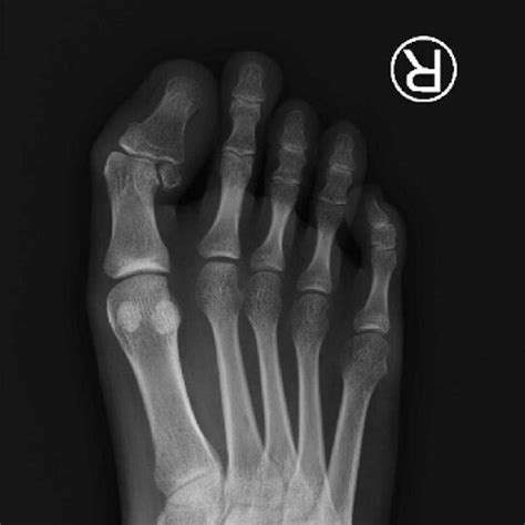 Lateral Deviation Of Great Toe Interphalangeal Joint As Much As