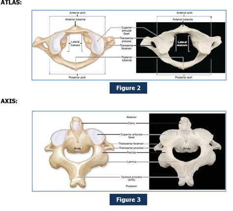 Radiological Evaluation Of Craniovertebral Junction Anomalies Semantic Scholar