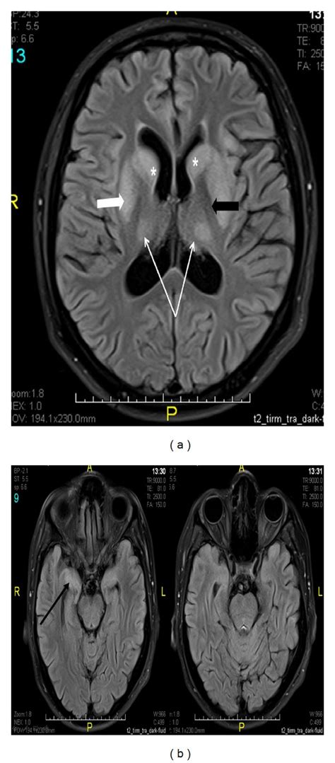 A Mri Brain Axial Flair Image Showing Hyperintense Signal In The