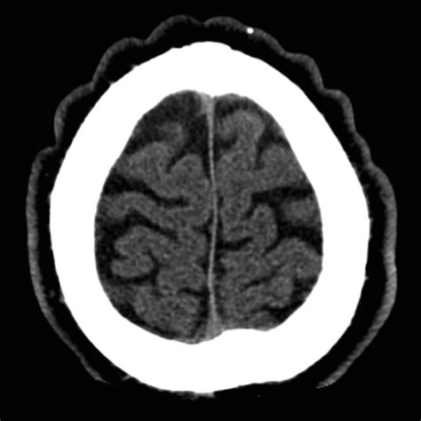 A, Anterior-posterior folding of the scalp (patient 1). B ...