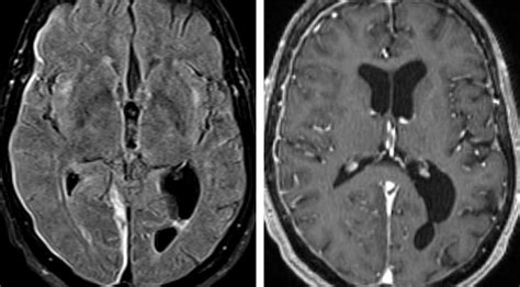subdural hematoma sdh cohen collection volumes