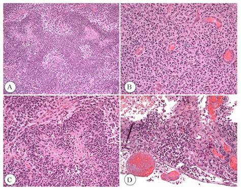 Histopathological Analysis Of Excised Brain Tumor Tissue H E A