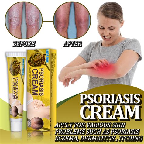 Psoriasis Cream Dermatitis Treatment Eczema Cream Ubat Gatal Gatal