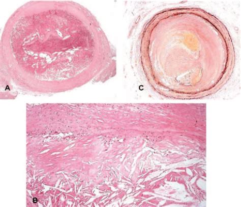 Figure 1 From Percutaneous Recanalization Of Chronically Occluded