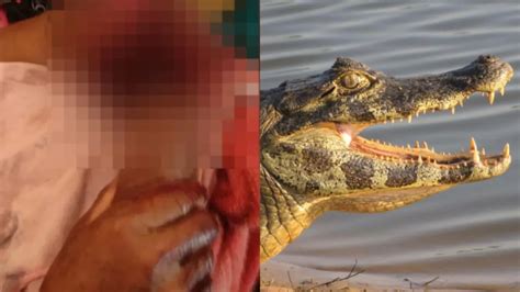 Homem Tem Bra O Dilacerado Durante Ataque De Jacar Pantanal Oficial