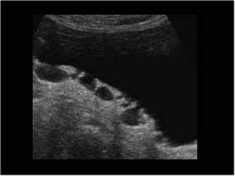 Urinary Tract and male reproductive system | 2.2 Bladder : Case 2.2.3 ...