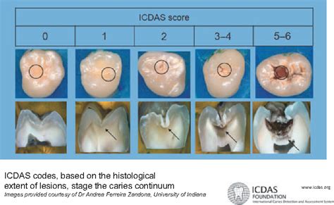 Figure 1 From International Caries Detection And Assessment System