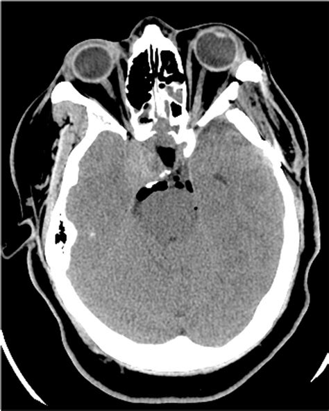 Figure 1 From Treatment Of Pneumocephalus After Endoscopic Sinus And