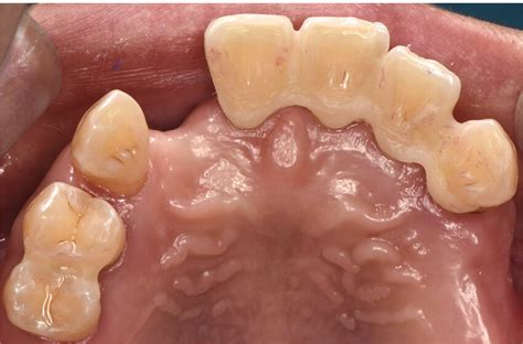 Periodontal Splint In The Palatal Aspect Of Mobile Teeth In Maxillary