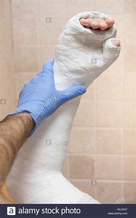 Orthopedic Technician Putting On A Fiberglass Plaster Cast On A Young