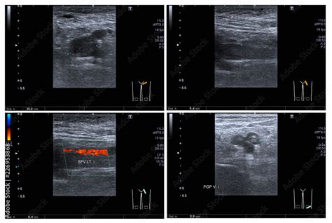 Ultrasound color doppler both leg:Hyperechoic thrombus with dilatation of veins, at Lt ...