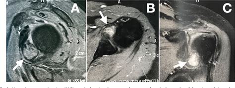 Figure From Localized Pigmented Villonodular Synovitis In The