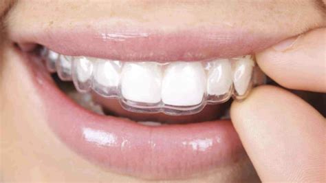 Retenedores dentales qué son Clínica Garden