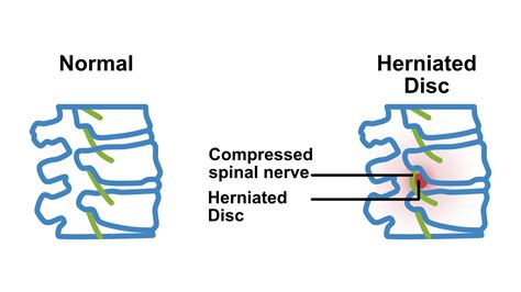 Lumbar Disc Herniation Types