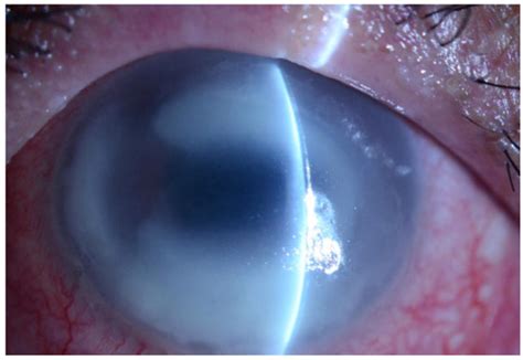 Biology Free Full Text New Frontiers In Acanthamoeba Keratitis Diagnosis And Management