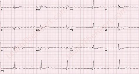 Heart Blocks ECG 25 Learn The Heart