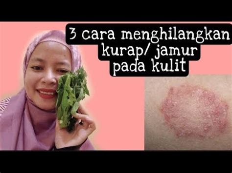 Cara Mengobati Jamur Kulit Obat Kadas Kurap Dengan Cara Alami