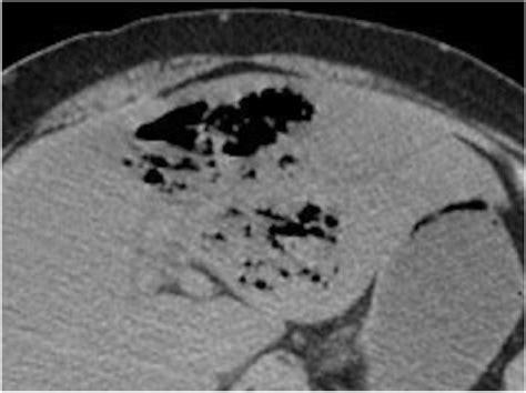 Abdominal Computed Tomography Showing A Gas Forming Lesion In The Left