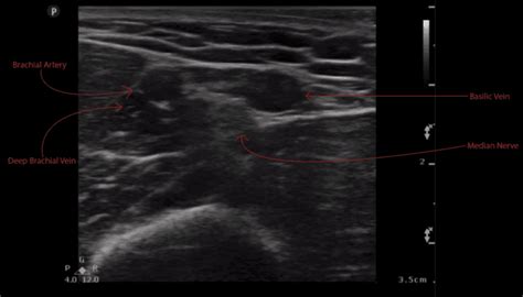 Easy Ivs Are Better Than Ultrasound Ivs In Easy Access Syed Prompeat