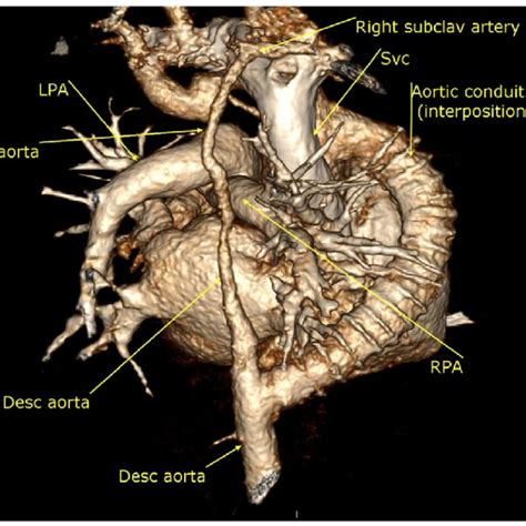 D Mdct Volume Rendering Image Shows The Interruption Segment And Long