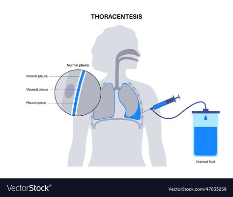 Thoracentesis Procedure