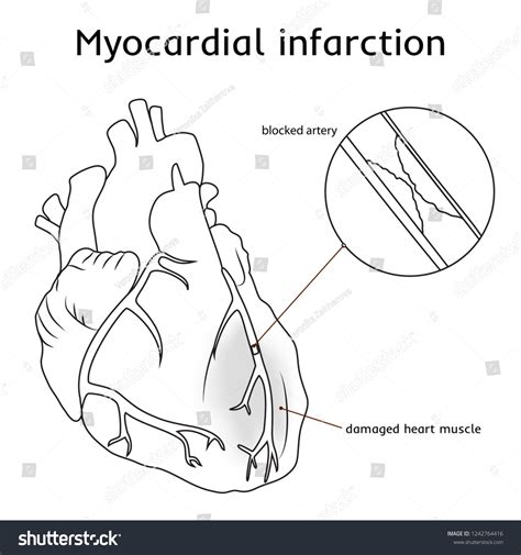 Myocardial Infarction Heart Attack Blocked Artery Vector De Stock