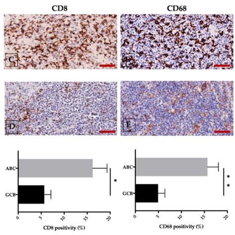 Abc Upper Panel And Gcb Middle Panel Dlbcl Different Expression Of