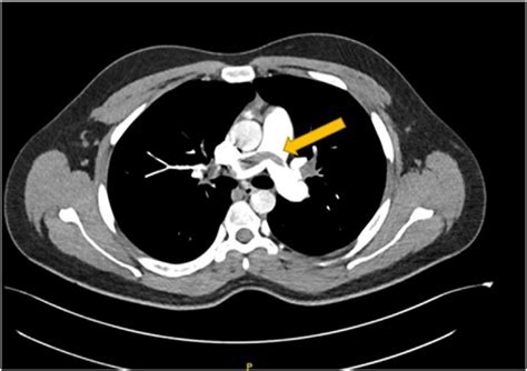 CTA chest axial view showing the saddle thrombus (arrow) at the ...