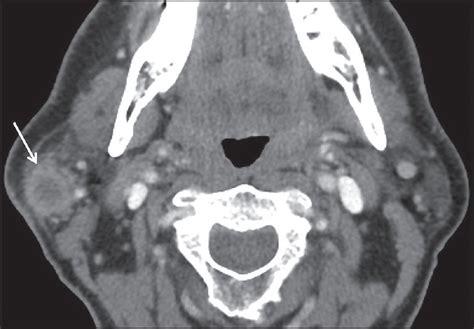 Parotid Gland Tumor Mri