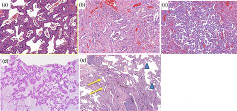 Histopathology Patterns Of Early Stage Lung Adenocarcinoma All