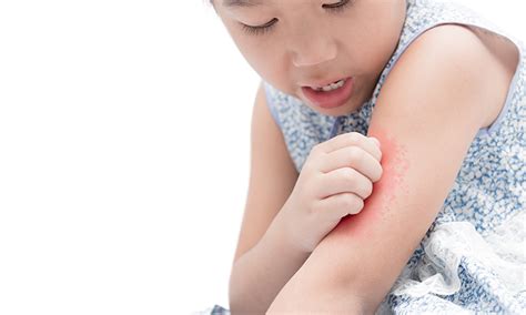 Atopic Dermatitis CME - Children & Adolescent Dermatitis | myCME