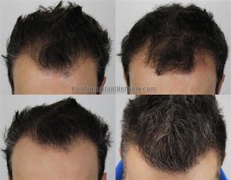 Dr H Rahal Hair Restoration Surgery Before And After Result Images