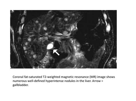 Pediatric Liver Masses Ppt