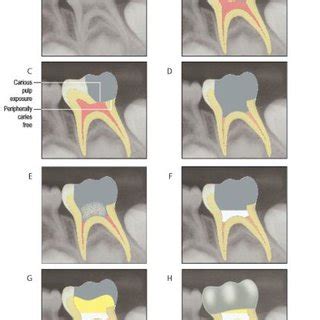 PDF The Effectiveness Of One Visit Vital Pulpotomy In Primary Teeth