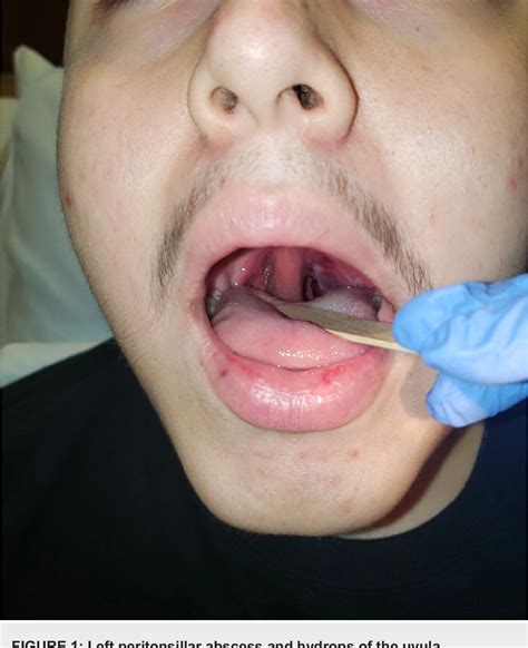 Figure 1 From Concurrent Peritonsillar Abscess And Uvular Hydrops In A