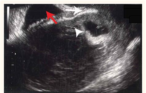 Vaginal Ultrasound Showing A Pregnancy In The Caesarean Scar Site