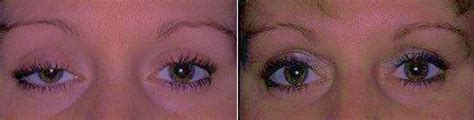 Before And After Eyesthetics At Sabates Eye Center