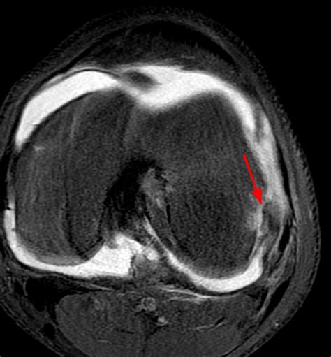 Pathology of the Popliteus Tendon | Radsource