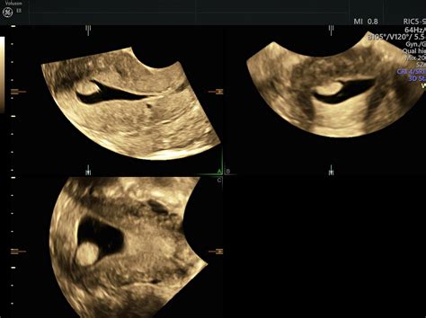 Endometrial Polyp Ultrasound And Sis The Gold Standard Empowered Women