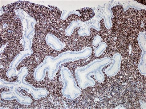 The Neoplastic Lymphoid Cells Demonstrated Strong Diffuse Nuclear