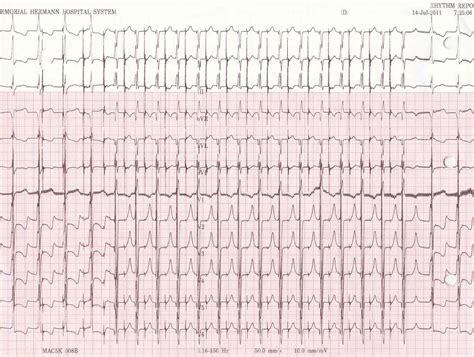 Pedi cardiology: EP, ICU: Junctional Tachycardia vs. Ventricular ...