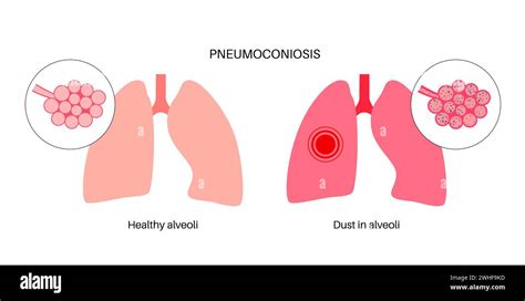 Pneumoconiosis Lung Disease Illustration Stock Photo Alamy