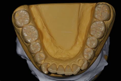 Diagnostisches Wax Up Zahntechnisches Laboratorium Harald G Bel Gmbh