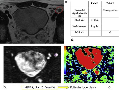 An example of benign lymph node. (a) T2w image. (b) DW image. (c) ADC ...