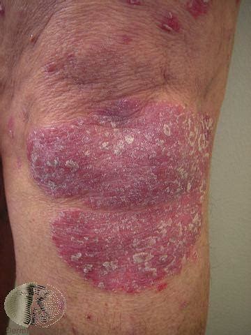 Psoriasis Treatment - Colorado Springs & Monument,CO