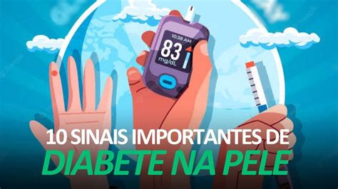 Você sabe RECONHECER os sinais de DIABETES na pele YouTube